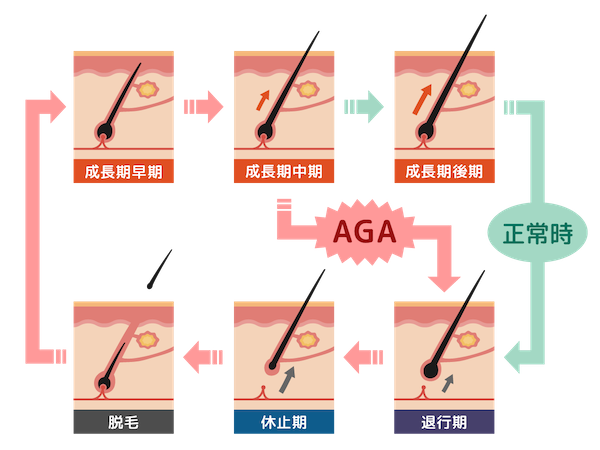 AGA薄毛の髪のサイクルのイメージ像