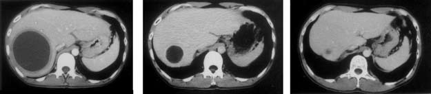 肝膿瘍のCT像
